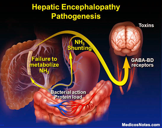 Pathogenesis of hepatic encephalopathy/ Image from RNpedia