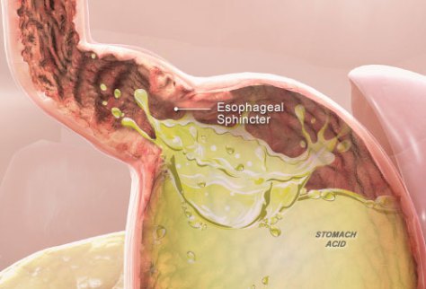 Heartburn – A Holistic Approach_acid-reflux-or-heart-burn