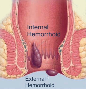 Hemorrhoid Prevention and Treatment_hemorrhoids
