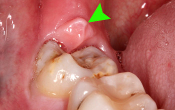 Pericoronitis dental photo