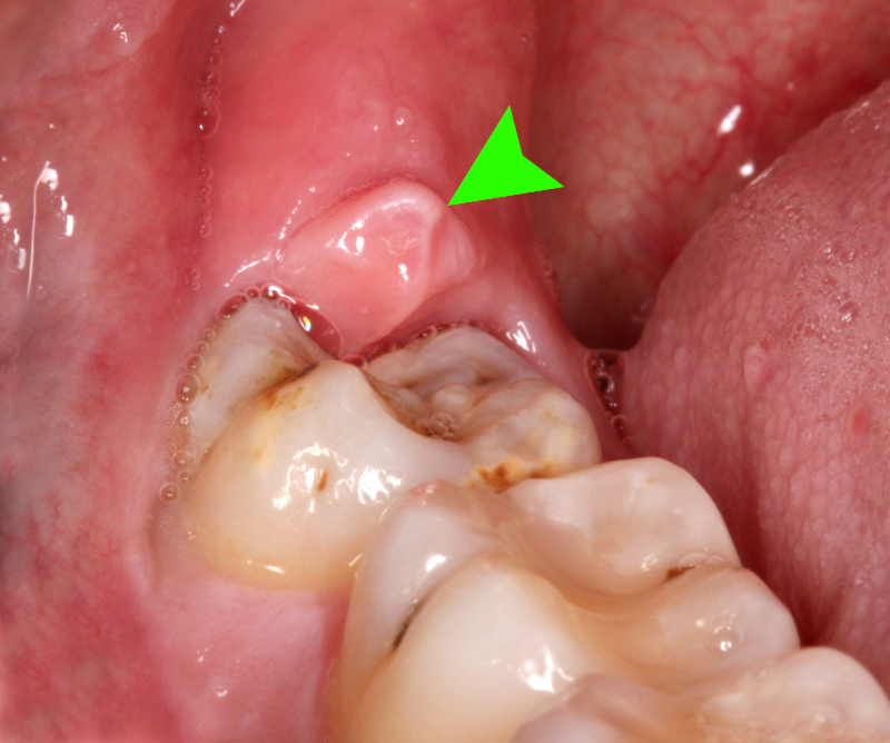Pericoronitis dental photo